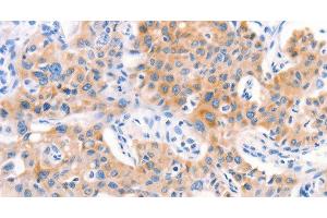 Immunohistochemistry of paraffin-embedded Human lung cancer tissue using Factor XIIIa Polyclonal Antibody at dilution 1:80 (F13A1 Antikörper)