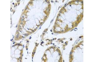 Immunohistochemistry of paraffin-embedded Human colon carcinoma using FBXL5 Polyclonal Antibody at dilution of 1:100 (40x lens). (FBXL5 Antikörper)