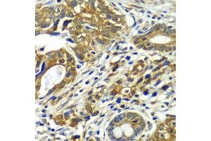 Immunohistochemistry of paraffin-embedded human gastric cancer using CDC16 antibody. (CDC16 Antikörper)