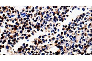 Immunohistochemistry of paraffin-embedded Human colon cancer tissue using ALOX5 Polyclonal Antibody at dilution 1:50 (ALOX5 Antikörper)