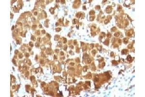 IHC testing of FFPE human melanoma with S100 beta antibody (clone S100B/1012).