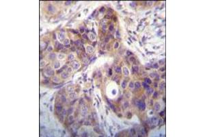 Immunohistochemical staining of formalin fixed and paraffin embedded human breast cancer was performed with KLK6 polyclonal antibody  at 1:10-1:50 dilution followed by indirect peroxidase conjugation with secondary antibody and DAB staining. (Kallikrein 6 Antikörper  (N-Term))