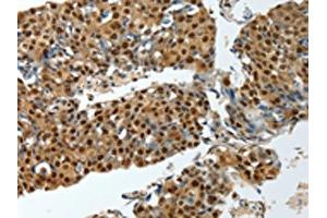 The image on the left is immunohistochemistry of paraffin-embedded Human breast cancer tissue using ABIN7193081(YBX1 Antibody) at dilution 1/15, on the right is treated with synthetic peptide. (YBX1 Antikörper)