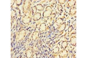 Immunohistochemistry of paraffin-embedded human gastric cancer using ABIN7148710 at dilution of 1:100 (CTDNEP1A Antikörper  (AA 3-244))