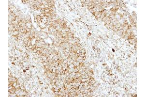 IHC-P Image Immunohistochemical analysis of paraffin-embedded human breast cancer, using EEN, antibody at 1:250 dilution. (SH3GL1 Antikörper  (Center))