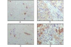 Immunohistochemical analysis of paraffin-embedded human brain hippocampus (A), lung cancer (B), brain tumor (C), breast cance (D), showing cytoplasmic localization with DAB staining using CRYAB antibody. (CRYAB Antikörper  (AA 1-175))