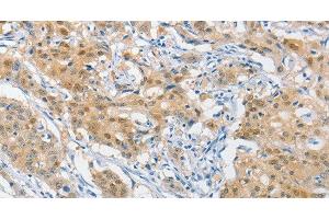 Immunohistochemistry of paraffin-embedded Human gastric cancer using HSP40 Polyclonal Antibody at dilution of 1:40 (DNAJB1 Antikörper)