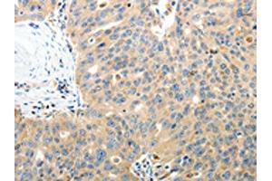 The image on the left is immunohistochemistry of paraffin-embedded Human ovarian cancer tissue using ABIN7130809(RAMP3 Antibody) at dilution 1/40, on the right is treated with fusion protein.