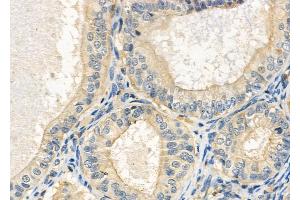 ABIN6264184 and ABIN6272389 at 1/100 staining Human ovarian cancer and adjacent normal tissues by IHC-P. (OLFML2B Antikörper  (Internal Region))