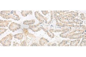 Immunohistochemistry of paraffin-embedded Human thyroid cancer tissue using EPRS Polyclonal Antibody at dilution of 1:60(x200) (EPRS Antikörper)