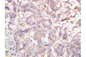 Formalin-fixed and paraffin embedded human lung cancer labeled with Rabbit Anti-TRIB2 Polyclonal Antibody, Unconjugated  at 1:200 followed by conjugation to the secondary antibody and DAB staining
