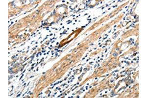 The image on the left is immunohistochemistry of paraffin-embedded Human gastric cancer tissue using ABIN7192673(STEAP4 Antibody) at dilution 1/25, on the right is treated with synthetic peptide. (STEAP4 Antikörper)
