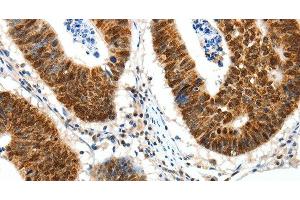 Immunohistochemistry of paraffin-embedded Human colon cancer tissue using SP1 Polyclonal Antibody at dilution 1:30 (SP1 Antikörper)