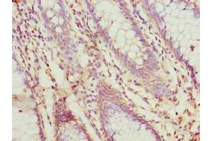 Immunohistochemistry of paraffin-embedded human colon cancer using ABIN7156187 at dilution of 1:100 (PRSS35 Antikörper  (AA 201-413))