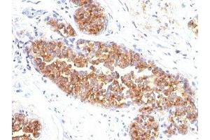 Formalin-fixed, paraffin-embedded human breast carcinoma stained with MUC1 / EMA antibody (MUC1/845). (MUC1 Antikörper)