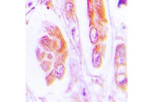 Immunohistochemical analysis of Caspase 7 staining in human lung cancer formalin fixed paraffin embedded tissue section. (Caspase 7 Antikörper  (Center))