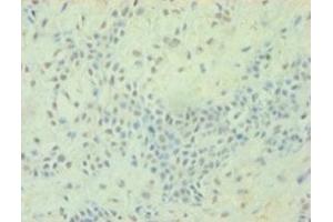 Immunohistochemistry of paraffin-embedded human breast cancer using ABIN7172823 at dilution of 1:100 (TGFB2 Antikörper  (AA 304-413))
