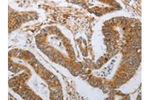 The image on the left is immunohistochemistry of paraffin-embedded Human colon cancer tissue using ABIN7191632(NEUROG1 Antibody) at dilution 1/25, on the right is treated with synthetic peptide. (Neurogenin 1 Antikörper)