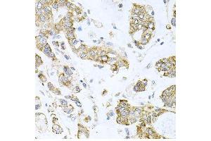 Immunohistochemistry of paraffin-embedded human gastric cancer using ALKBH8 antibody. (ALKBH8 Antikörper  (AA 1-230))