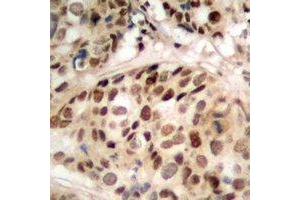 Immunohistochemical analysis of PHF1 staining in human prostate cancer formalin fixed paraffin embedded tissue section. (PHF1 Antikörper)