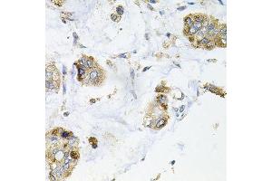 Immunohistochemistry of paraffin-embedded human gastric cancer using GALC antibody. (GALC Antikörper  (AA 40-300))