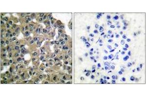 Immunohistochemistry analysis of paraffin-embedded human breast carcinoma tissue, using MAGE-1 Antibody. (MAGEA1 Antikörper  (AA 260-309))