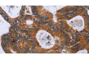 Immunohistochemistry of paraffin-embedded Human colon cancer using GH2 Polyclonal Antibody at dilution of 1:40 (Growth Hormone 2 Antikörper)