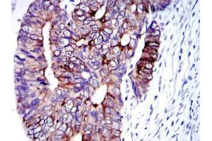 Immunohistochemical analysis of paraffin-embedded human colon cancer tissues using KRT19 mouse mAb with DAB staining.