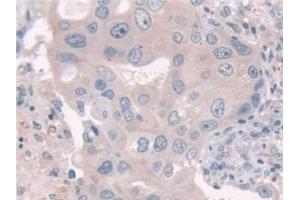 Detection of USP6NL in Human Breast cancer Tissue using Polyclonal Antibody to USP6 N-Terminal Like Protein (USP6NL)