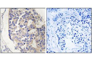 Immunohistochemistry analysis of paraffin-embedded human breast carcinoma tissue, using C1S antibody. (C1S Antikörper)