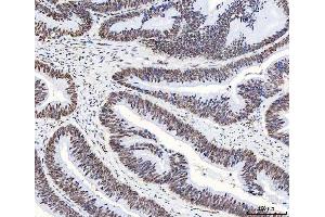 IHC analysis of HnRNP H/HNRNPH1 using anti-HnRNP H/HNRNPH1 antibody (ABIN4886623).