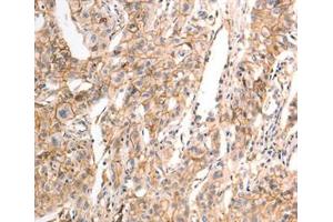 Immunohistochemical analysis of paraffin-embedded Human liver cancer tissue using at dilution 1/30. (CDH23 Antikörper  (C-Term))