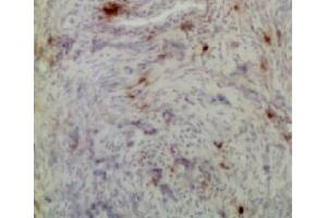 Frozen chicken ovarian tumor section was stained with Mouse Anti-Chicken CD8α-UNLB (CD8 alpha Antikörper)