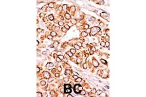 Formalin-fixed and paraffin-embedded human cancer tissue reacted with PIP5K3 polyclonal antibody  , which was peroxidase-conjugated to the secondary antibody, followed by AEC staining.