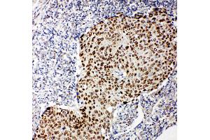Anti-p63 antibody, IHC(P) IHC(P): Human Lung Cancer Tissue (p63 Antikörper  (C-Term))