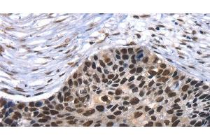 Immunohistochemistry (Paraffin-embedded Sections) (IHC (p)) image for anti-TAF15 RNA Polymerase II, TATA Box Binding Protein (TBP)-Associated Factor, 68kDa (TAF15) antibody (ABIN7239500)