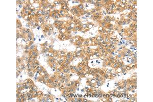 Immunohistochemistry of Human lung cancer using PTPN4 Polyclonal Antibody at dilution of 1:40 (PTPN4 Antikörper)