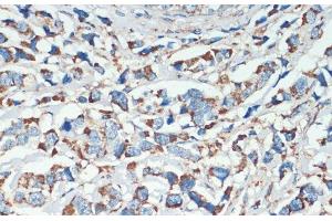 Immunohistochemistry of paraffin-embedded Human breast cancer using APC Polyclonal Antibody at dilution of 1:200 (40x lens). (APC Antikörper)