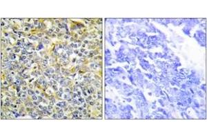 Immunohistochemistry analysis of paraffin-embedded human lung carcinoma tissue, using TFIP8 Antibody. (Cytokeratin 5 Antikörper  (AA 31-80))
