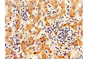 IHC image of ABIN7156517 diluted at 1:300 and staining in paraffin-embedded human liver cancer performed on a Leica BondTM system. (ITIH4 Antikörper  (AA 689-930))