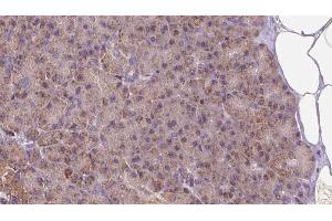 ABIN6273261 at 1/100 staining Human pancreas cancer tissue by IHC-P. (LETM1 Antikörper  (Internal Region))