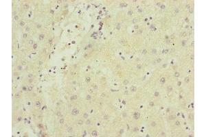 Immunohistochemistry of paraffin-embedded human liver cancer using ABIN7170343 at dilution of 1:100 (SAMM5 (AA 1-220) Antikörper)
