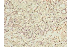 Immunohistochemistry of paraffin-embedded human pancreatic cancer using ABIN7173742 at dilution of 1:100 (TBCC Antikörper  (AA 2-346))