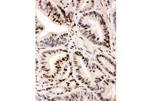 Anti-IRF1 antibody, IHC(P) IHC(P): Human Intestinal Cancer Tissue (IRF1 Antikörper  (Middle Region))