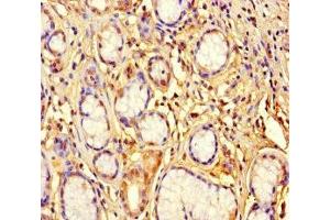 Immunohistochemistry of paraffin-embedded human gastric cancer using ABIN7176457 at dilution of 1:100 (ZNF627 Antikörper  (AA 1-300))