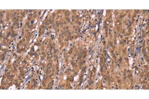 Immunohistochemistry of paraffin-embedded Human gasrtic cancer tissue using FBXO31 Polyclonal Antibody at dilution 1:40 (FBXO31 Antikörper)