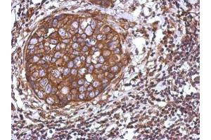 IHC-P Image Immunohistochemical analysis of paraffin-embedded human breast cancer, using TRIM25, antibody at 1:500 dilution. (TRIM25 Antikörper)