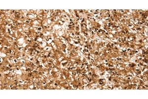 Immunohistochemistry of paraffin-embedded Human prostate cancer using RBM5 Polyclonal Antibody at dilution of 1:30 (RBM5 Antikörper)