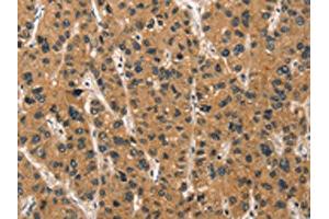 The image on the left is immunohistochemistry of paraffin-embedded Human liver cancer tissue using ABIN7190457(DEFA1/3 Antibody) at dilution 1/30, on the right is treated with synthetic peptide.