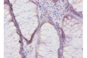 Immunohistochemistry of paraffin-embedded human colon cancer using ABIN7145472 at dilution of 1:50 (beta Defensin 1 Antikörper  (AA 33-68))